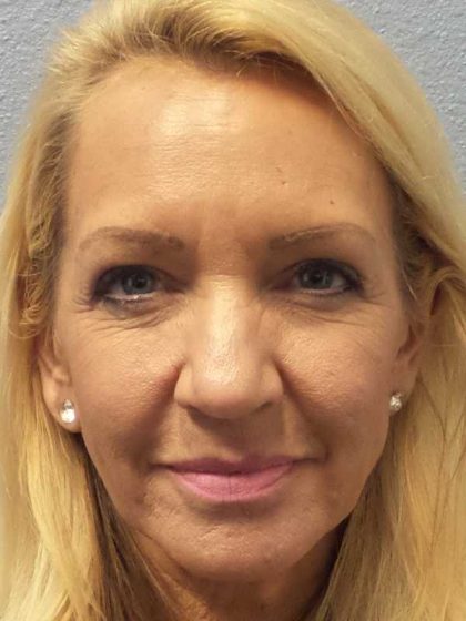 Resurfacing Before & After Patient #12329