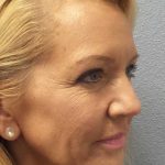Resurfacing Before & After Patient #12329