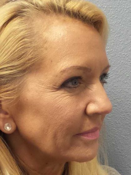 Resurfacing Before & After Patient #12329