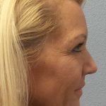 Resurfacing Before & After Patient #12329