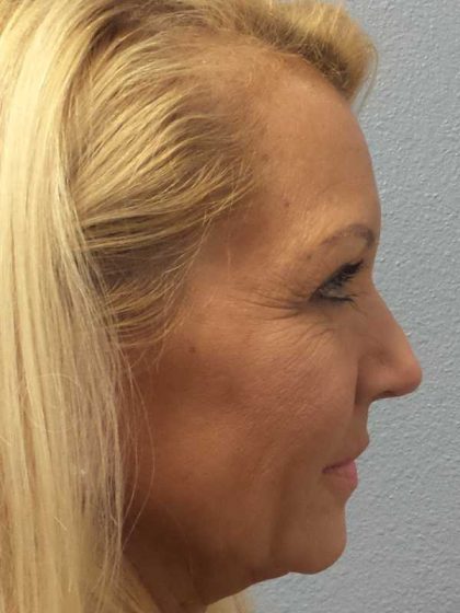 Resurfacing Before & After Patient #12329