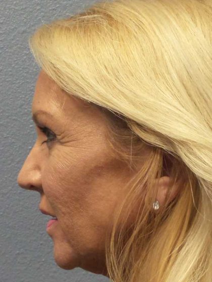 Resurfacing Before & After Patient #12329