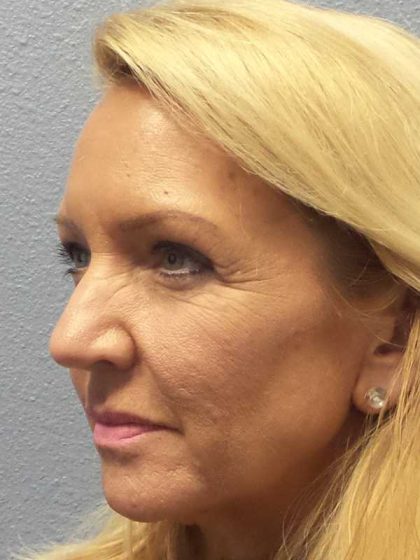 Resurfacing Before & After Patient #12329