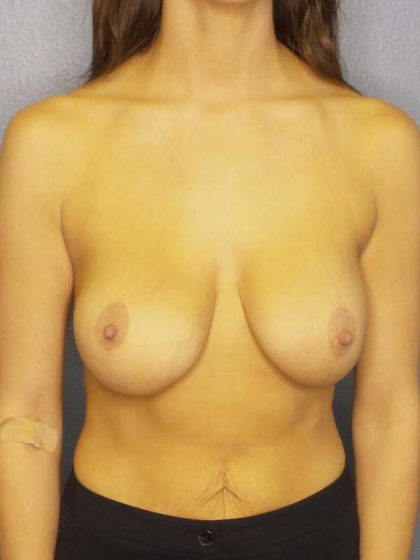 Augmentation Mastopexy Revision Before & After Patient #4752