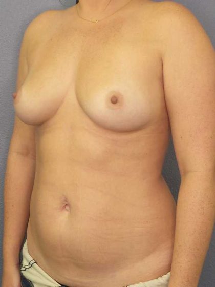 Asymmetric (Uneven) Breasts Before & After Patient #11425