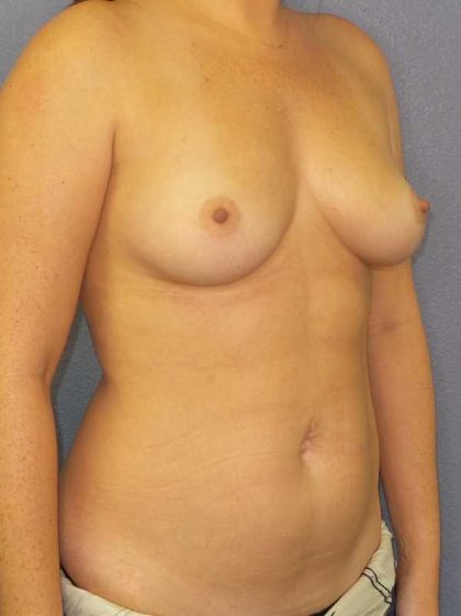 Asymmetric (Uneven) Breasts Before & After Patient #11425