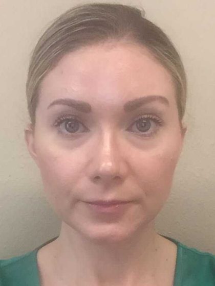 Filler Before & After Patient #11926