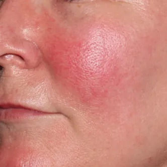 BroadBand Light (BBL™) Before & After Patient #13245