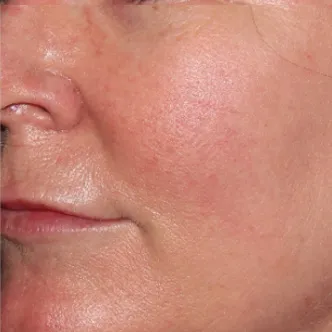 BroadBand Light (BBL™) Before & After Patient #13245