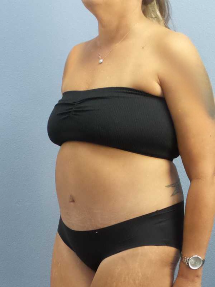 Abdominoplasty Before & After Patient #3594