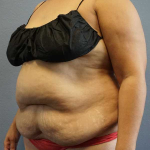 Abdominoplasty Before & After Patient #3437