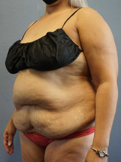 Abdominoplasty Before & After Patient #3437