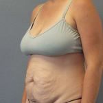 Abdominoplasty Before & After Patient #3409