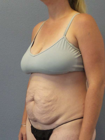 Abdominoplasty Before & After Patient #3409