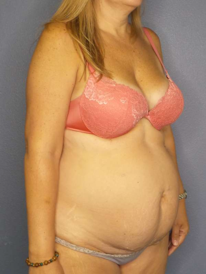 Abdominoplasty Before & After Patient #3350