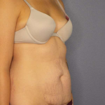 Abdominoplasty Before & After Patient #3236