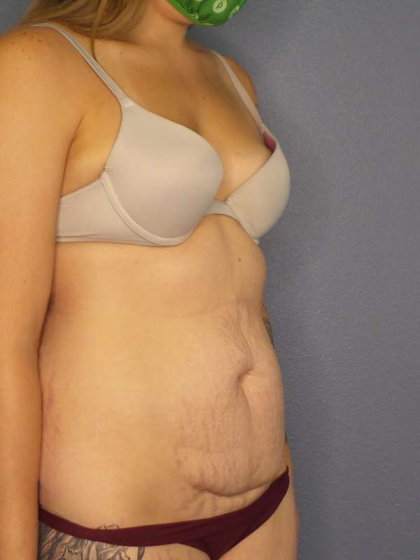 Abdominoplasty Before & After Patient #3236