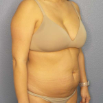 Abdominoplasty Before & After Patient #3225
