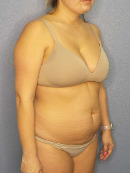 Abdominoplasty Before & After Patient #3225
