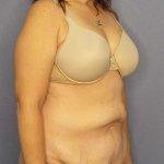 Abdominoplasty Before & After Patient #3188
