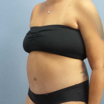 High BMI (Larger Patients) Surgery Before & After Patient #10380