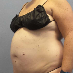 Liposuction Female Before & After Patient #11950