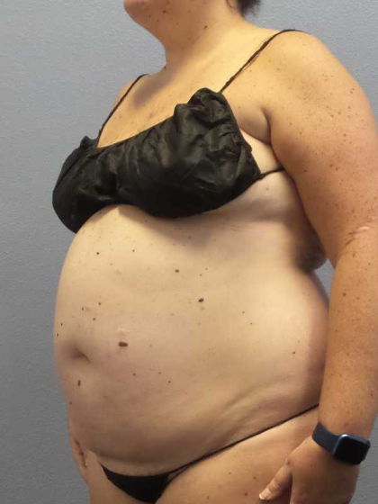 Liposuction Female Before & After Patient #11950