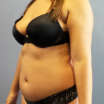 Liposuction Female Before & After Patient #11933