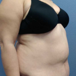 Abdominoplasty Before & After Patient #11131