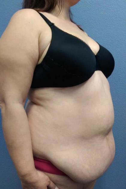 Abdominoplasty Before & After Patient #11131