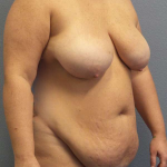 High BMI (Larger Patients) Surgery Before & After Patient #10431