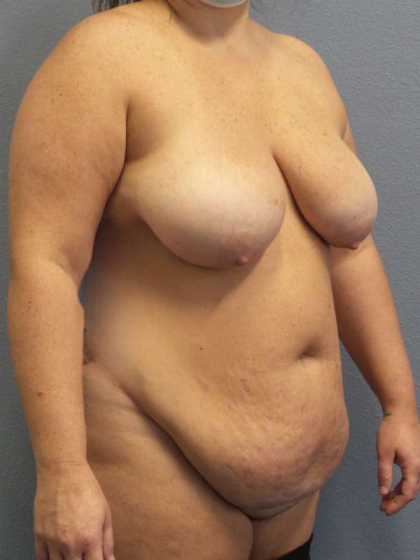 High BMI (Larger Patients) Surgery Before & After Patient #10431