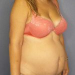 High BMI (Larger Patients) Surgery Before & After Patient #10329