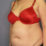 Liposuction Female Before & After Patient #7932