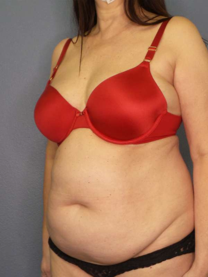 Liposuction Female Before & After Patient #7932