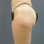 Liposuction Female Before & After Patient #7794