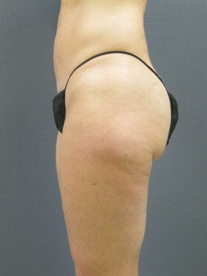 Liposuction Female Before & After Patient #7794