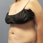 Abdominoplasty Before & After Patient #5197