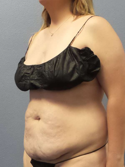 Abdominoplasty Before & After Patient #5197