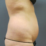 Liposuction Female Before & After Patient #7776