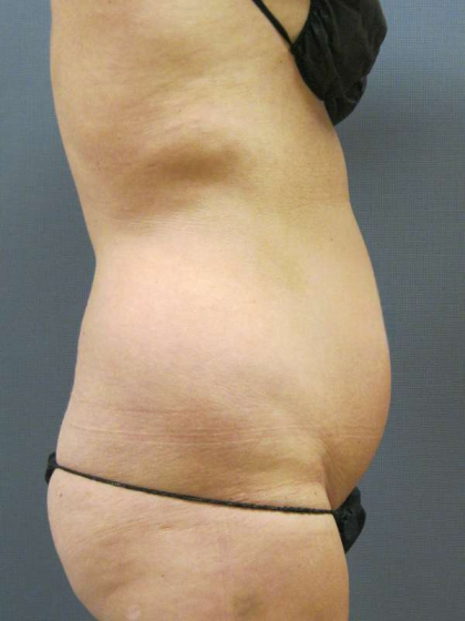 Liposuction Female Before & After Patient #7776