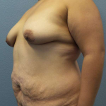 Abdominoplasty Before & After Patient #3735