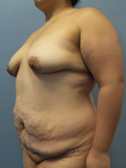 Abdominoplasty Before & After Patient #3735