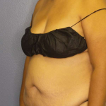 Abdominoplasty Before & After Patient #3638