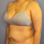 Abdominoplasty Before & After Patient #3583