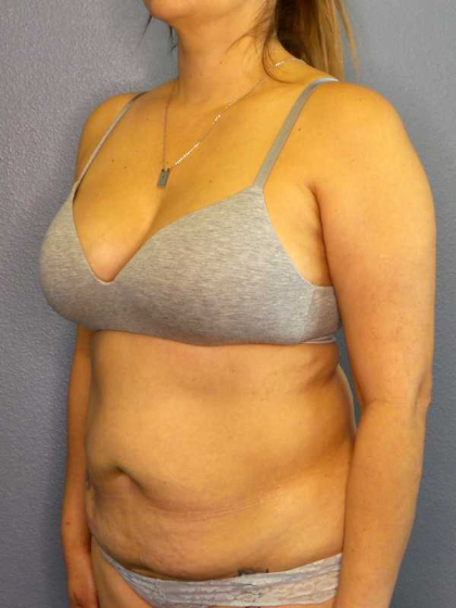 Abdominoplasty Before & After Patient #3583