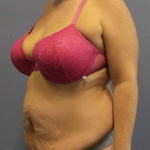 Abdominoplasty Before & After Patient #3572