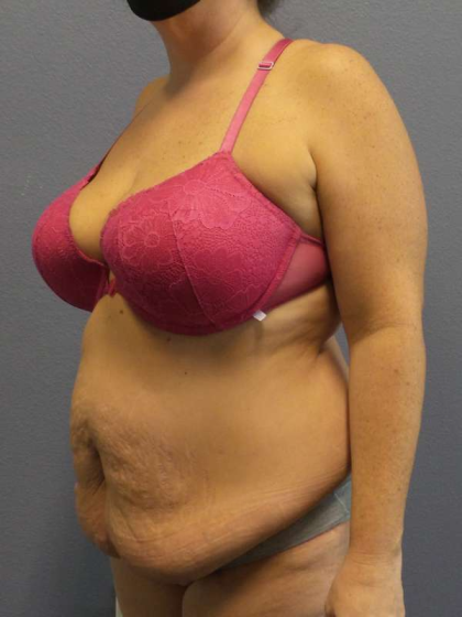 Abdominoplasty Before & After Patient #3572