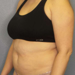 Liposuction Female Before & After Patient #7966