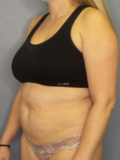Liposuction Female Before & After Patient #7966
